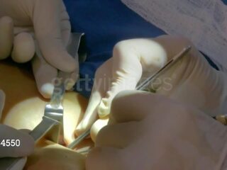Aj sotavento desde wwe consigue su third pecho implant: gratis sucio película 8e